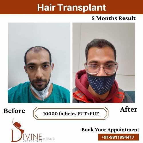 Hair-Transplant-Jan-10
