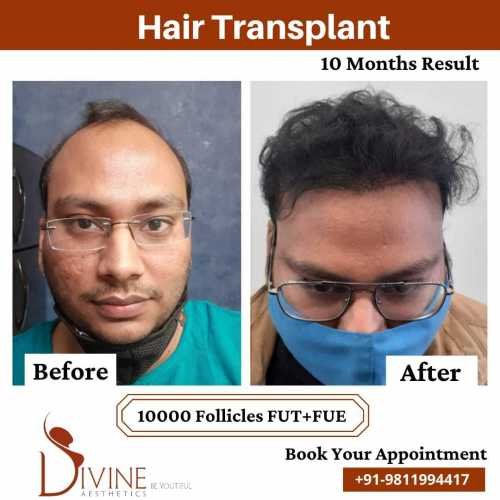 Hair-Transplant-Jan-2