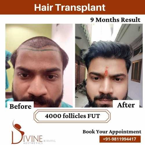 Hair-Transplant-Jan-3