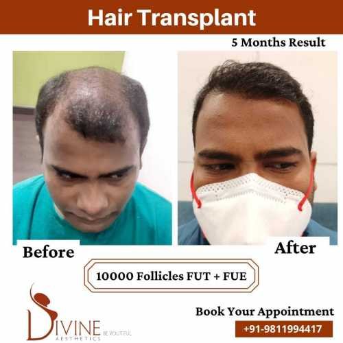 Hair-Transplant-Jan-4