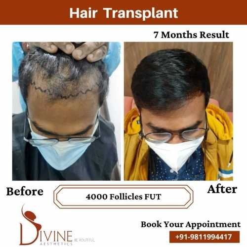 Hair-Transplant-Jan-5