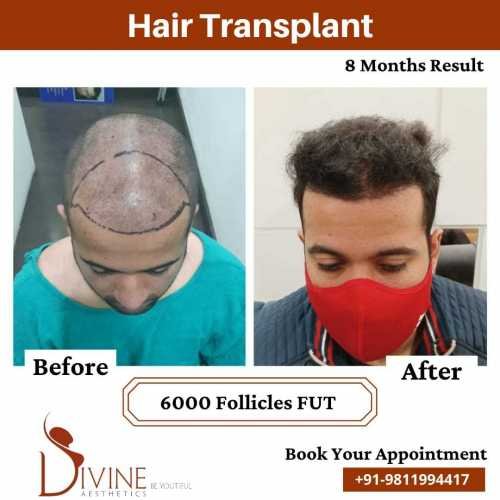 Hair-Transplant-Jan-6