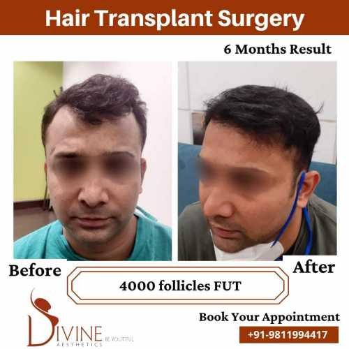 Hair-Transplant-Jan-7