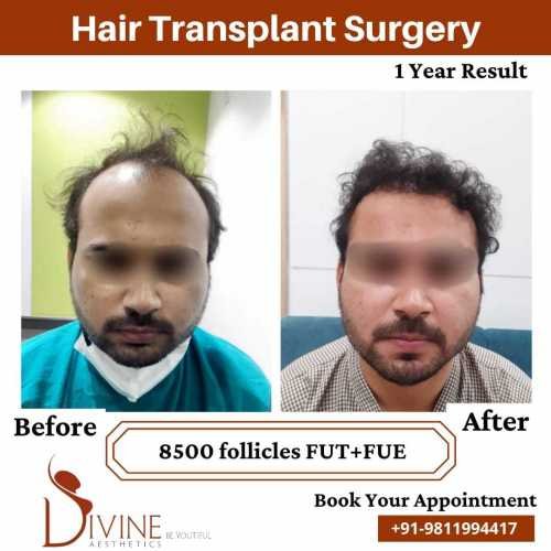 Hair-Transplant-Jan-8