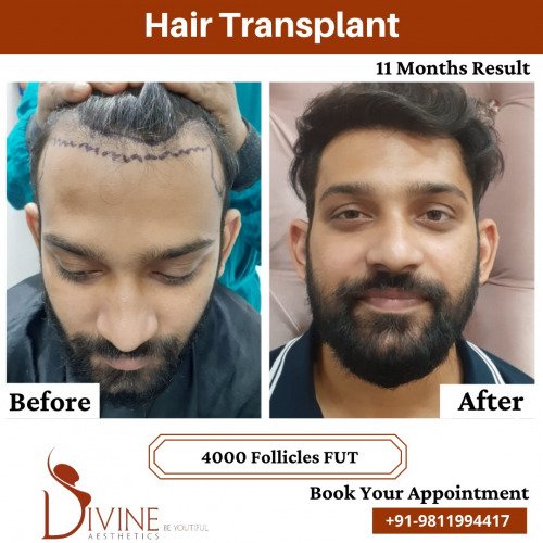 Hair-Transplant-before-after-1-March-2022
