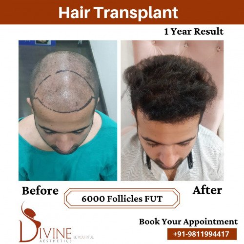Hair-Transplant-before-after-2-March-2022