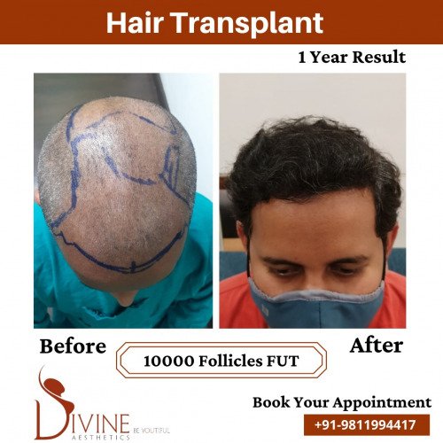Hair-Transplant-before-after-3-March-2022