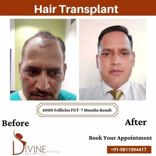 Hair-Transplant-before-after-picture-1