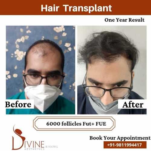 Hair-Transplant-before-after-picture-2