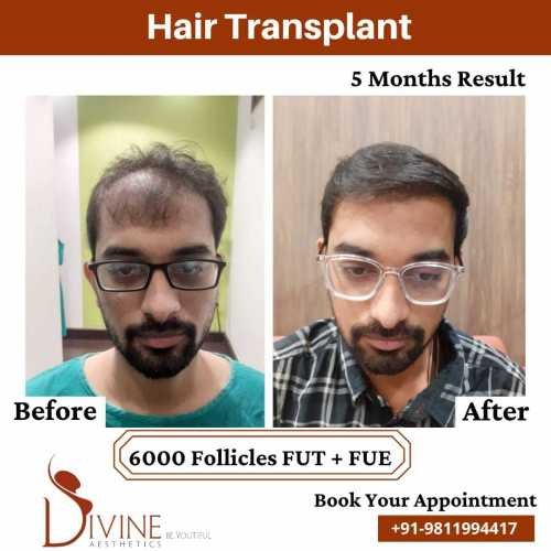 Hair-Transplant-by-Dr-Amit-Gupta-Dec-1