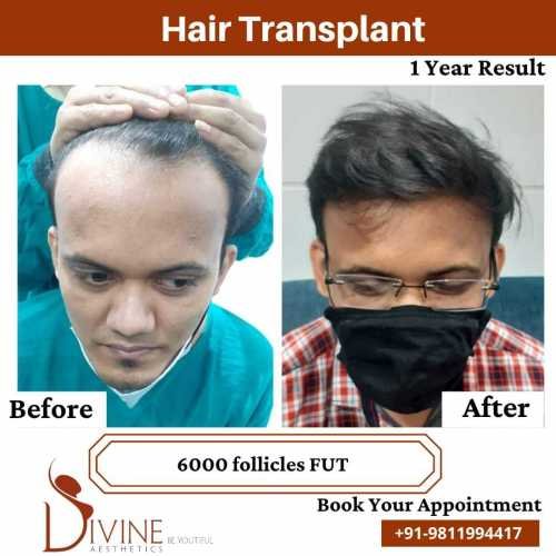 Hair-Transplant-by-Dr-Amit-Gupta-Dec-10