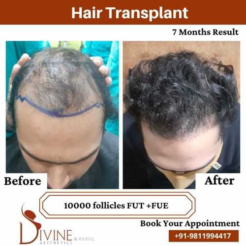 Hair-Transplant-by-Dr-Amit-Gupta-Dec-11