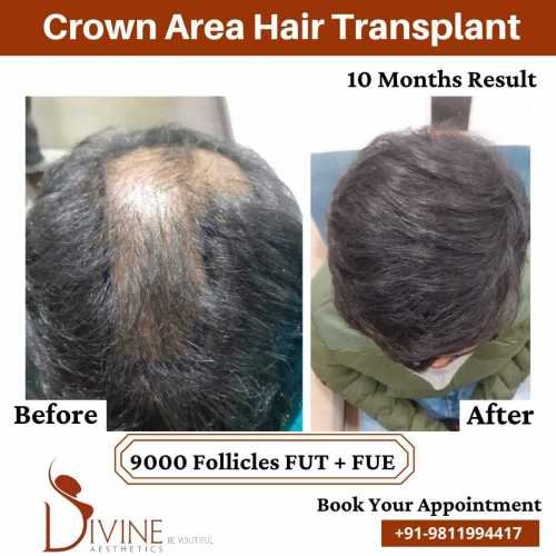 Hair-Transplant-by-Dr-Amit-Gupta-Dec-2