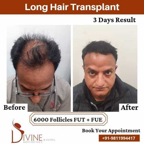 Hair-Transplant-by-Dr-Amit-Gupta-Dec-3