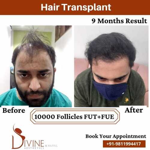 Hair-Transplant-by-Dr-Amit-Gupta-Dec-4