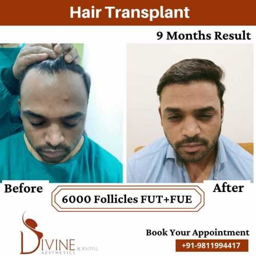 Hair-Transplant-by-Dr-Amit-Gupta-Dec-5