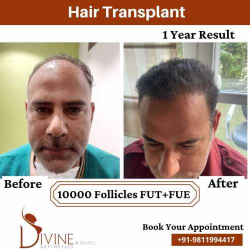 Hair-Transplant-by-Dr-Amit-Gupta-Dec-6