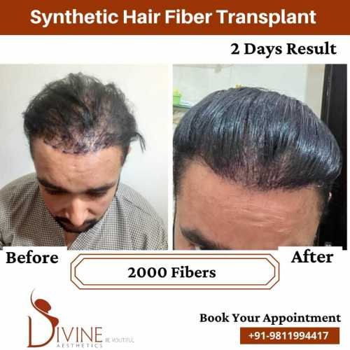 Hair-Transplant-by-Dr-Amit-Gupta-Dec-7
