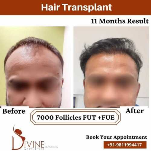 Hair-Transplant-by-Dr-Amit-Gupta-Dec-8