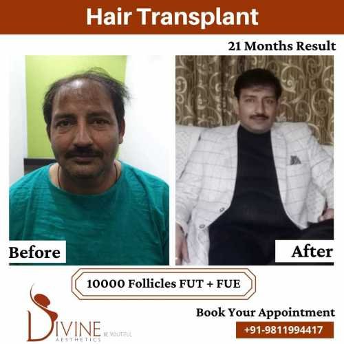 Hair-Transplant-by-Dr-Amit-Gupta-Dec-9