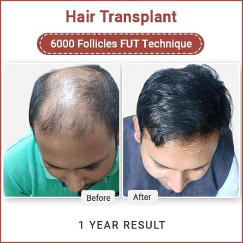 Hair transplant in Delhi