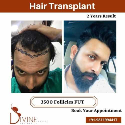 Hair-Transplant-results-from-FUT-techniques-surgery-done-by-Dr.-Amit-Gupta