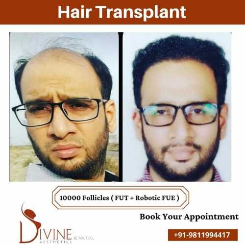 Hair-Transplant-results-from-FUTFUE-techniques-surgery-done-by-Dr.-Amit-Gupta