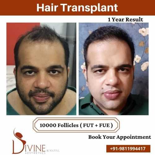 Hair-Transplant-results-from-FUTFUE-techniques-surgery-done-by-Dr.-Amit