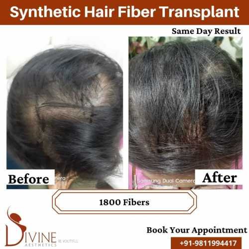 Synthetic-Hair-Transplant-2