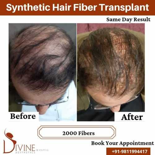 Synthetic-Hair-Transplant-3