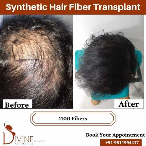 Synthetic-Hair-Transplant-4