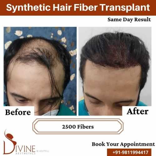 Synthetic-Hair-Transplant-5