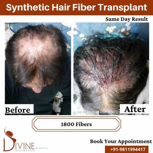 Synthetic-Hair-Transplant-6