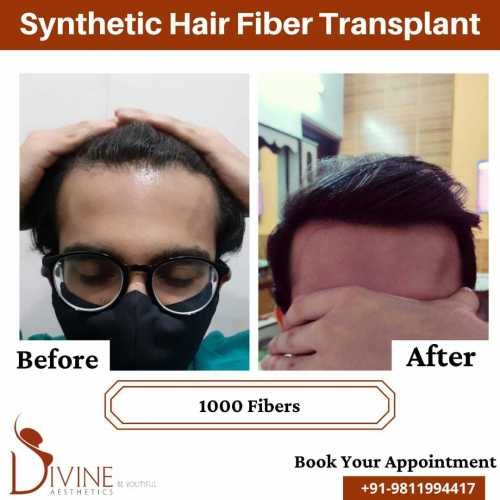 Synthetic-Hair-Transplant