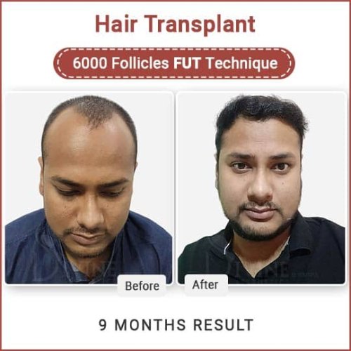 hair transplant in Delhi