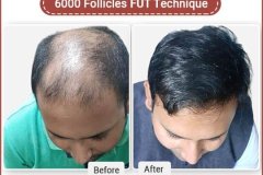 Hair transplant in Delhi