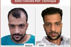 best hair transplant surgery in Delhi