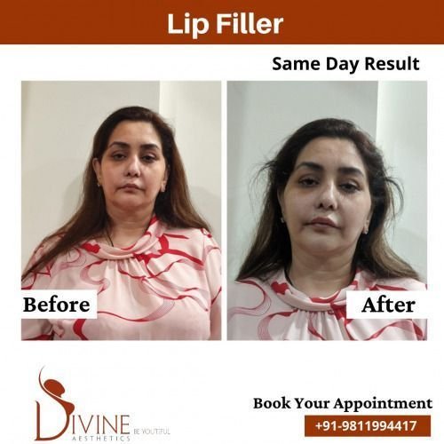 Lip-Filler-Before-After-1-Feb-22.jpeg-nggid03481-ngg0dyn-500x500x100-00f0w010c010r110f110r010t010