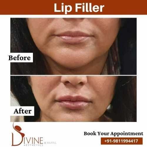 Lip-Filler-before-after-Jan-1.jpeg-nggid03447-ngg0dyn-500x500x100-00f0w010c010r110f110r010t010