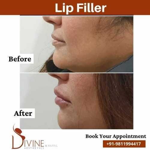 Lip-Filler-before-after-Jan-2.jpeg-nggid03446-ngg0dyn-500x500x100-00f0w010c010r110f110r010t010