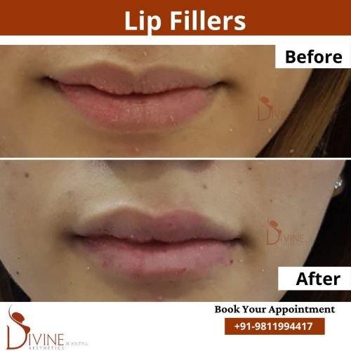 Lip-Fillers-1