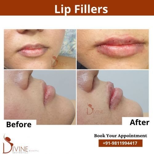 Lip-Fillers-4.png-nggid03105-ngg0dyn-500x500x100-00f0w010c010r110f110r010t010