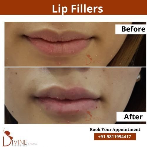 Lip-Fillers-5.png-nggid03106-ngg0dyn-500x500x100-00f0w010c010r110f110r010t010