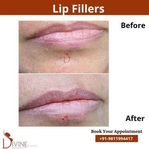 Lip-Fillers-6.png-nggid03107-ngg0dyn-500x500x100-00f0w010c010r110f110r010t010