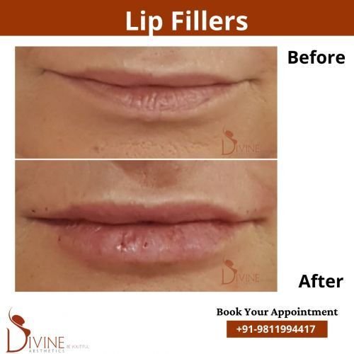 Lip-Fillers.png-nggid03108-ngg0dyn-500x500x100-00f0w010c010r110f110r010t010