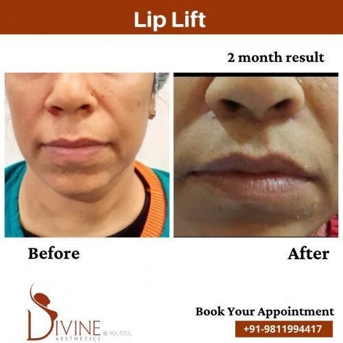 Lip-Lift-before-after-1-March-2022.jpeg-nggid03514-ngg0dyn-500x500x100-00f0w010c010r110f110r010t010