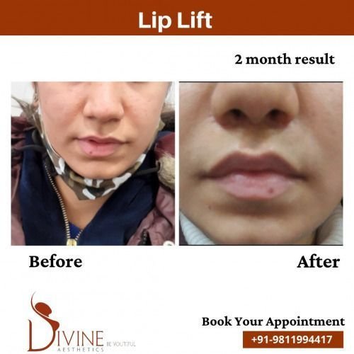 Lip-Lift-before-after-2-March-2022.jpeg-nggid03513-ngg0dyn-500x500x100-00f0w010c010r110f110r010t010