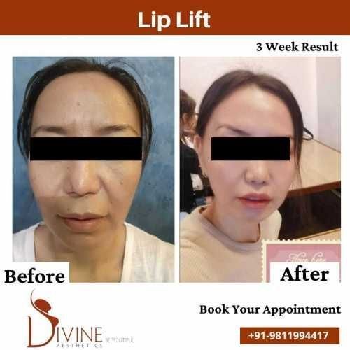 Lip-lift-before-after-by-dr-amit-gupta.jpeg-nggid03329-ngg0dyn-500x500x100-00f0w010c010r110f110r010t010