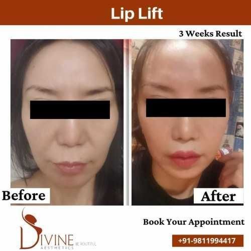 Lip-lift-before-after-result-by-dr-amit-gupta.jpeg-nggid03328-ngg0dyn-500x500x100-00f0w010c010r110f110r010t010