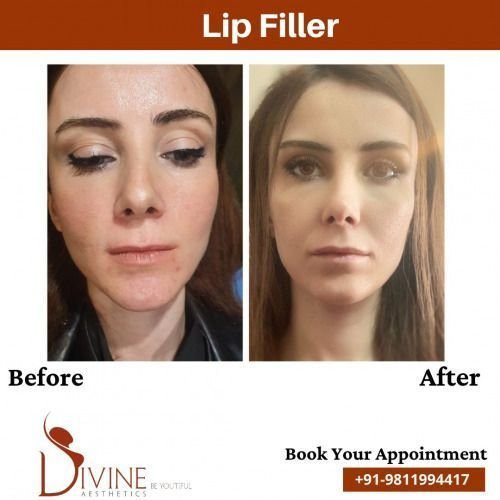 lip-Filler-Before-After-2-Feb-22.jpeg-nggid03480-ngg0dyn-500x500x100-00f0w010c010r110f110r010t010
